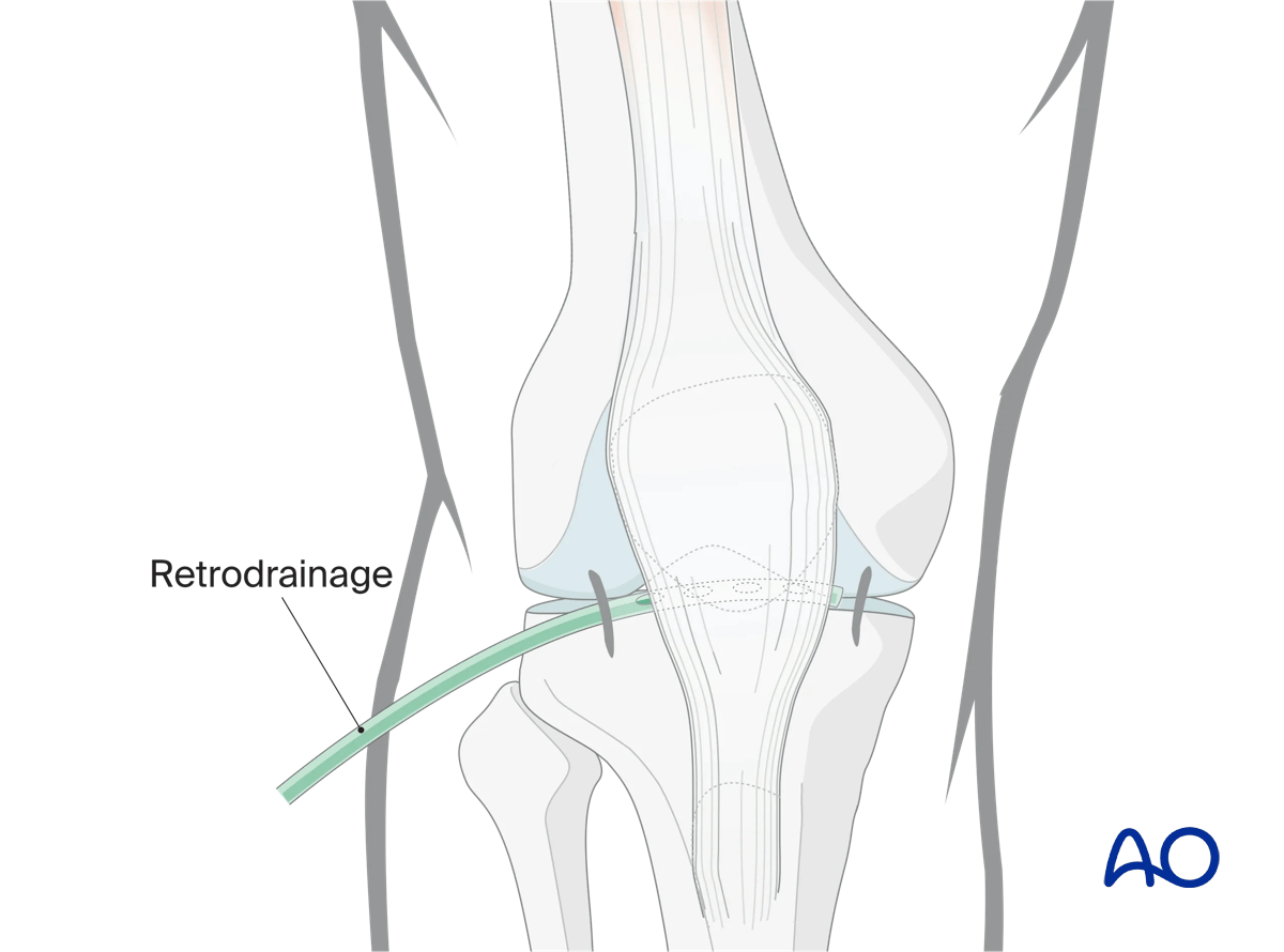 Arthroscopic approach to the knee, retrodrainage and wound closure