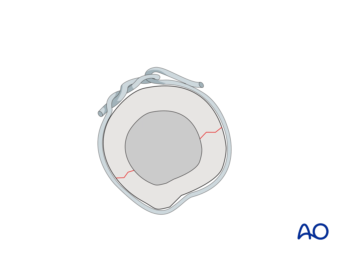 Twist knot, single loop, or double loop cerclage wire can be used.