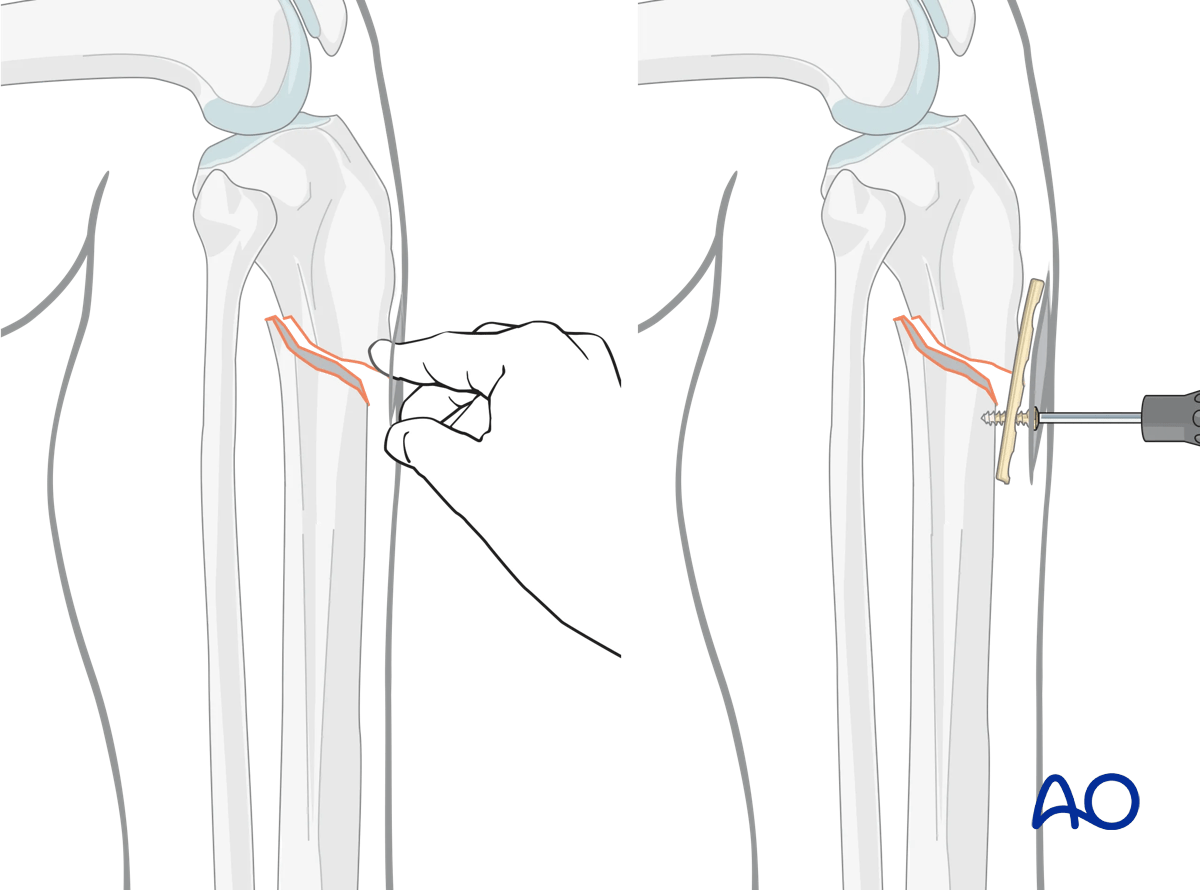 Lateral parapatellar intramedullary nailing of the tibial shaft, Reduction and preliminary fixation