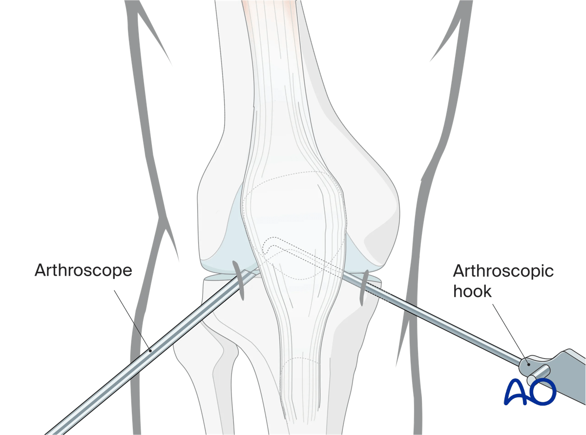 Arthroscopic approach to the knee, Anteromedial incision
