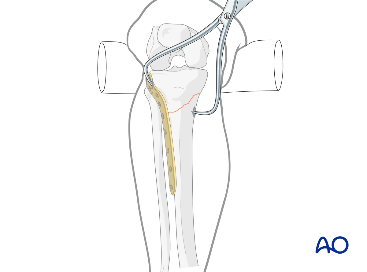 Proximal tibia: Simple extraarticular fracture of the metaphysis Angular stable plating – positioning of the plate