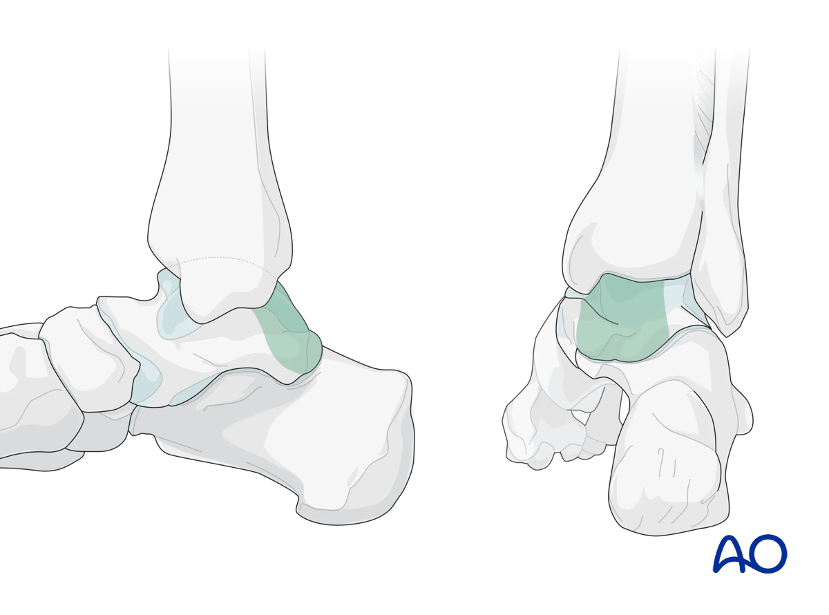 Talus area visible through the posteromedial surgical approach