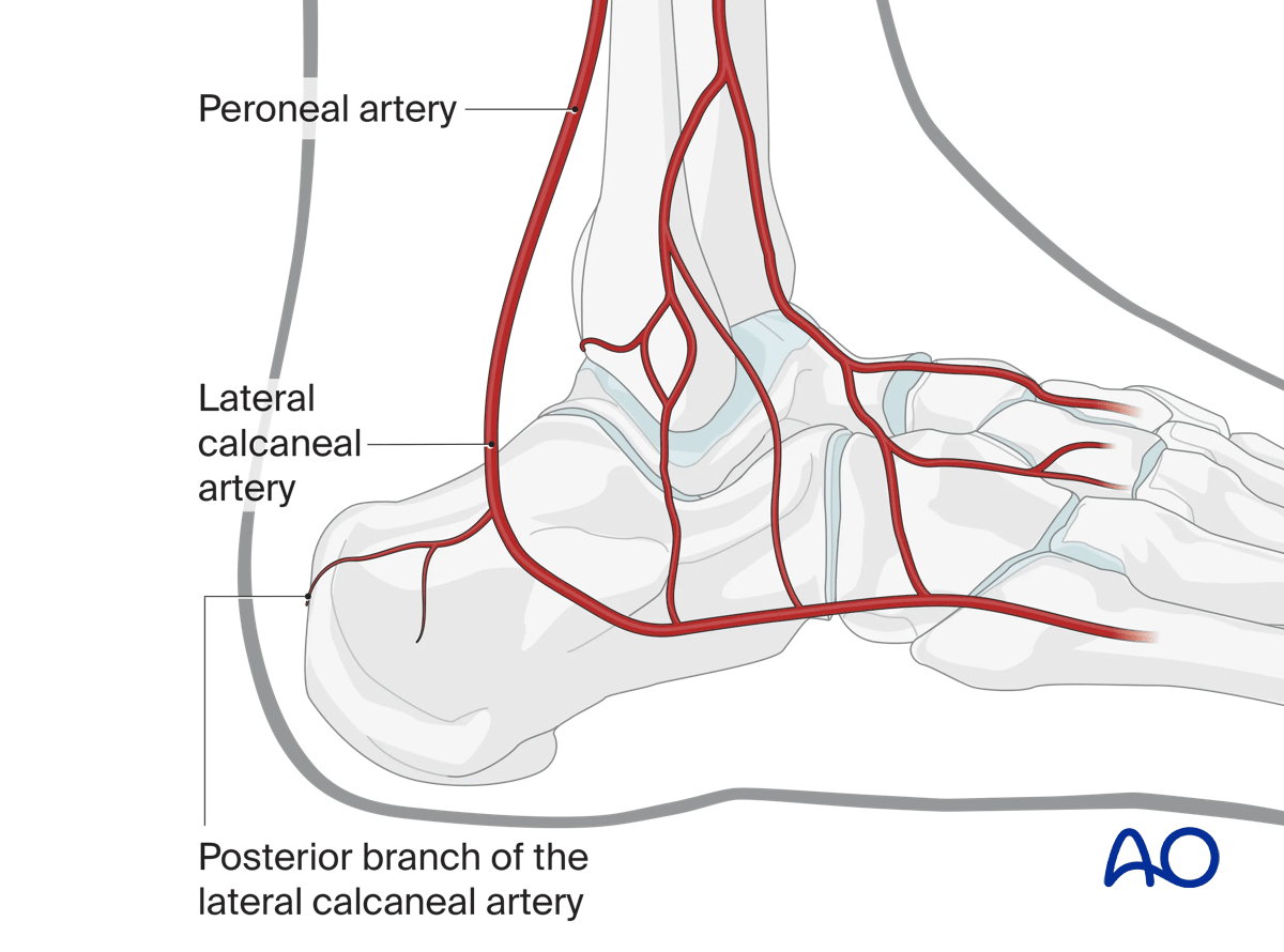 Sinus tarsi approach to the calcaneus preserving lateral calcaneal artery blood supply