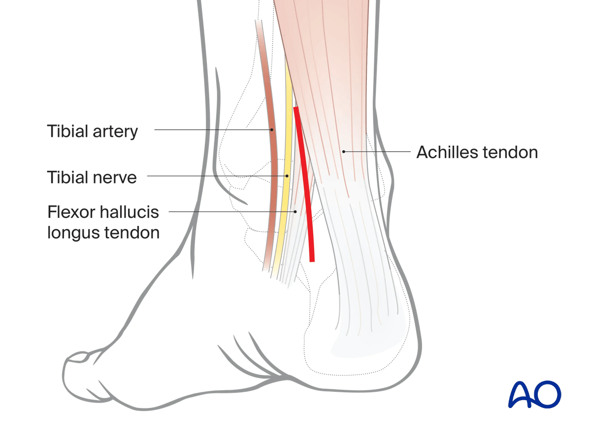 Posteromedial talus approach incision between Achilles and medial malleolus, centered over subtalar joint (fluoro-guided)