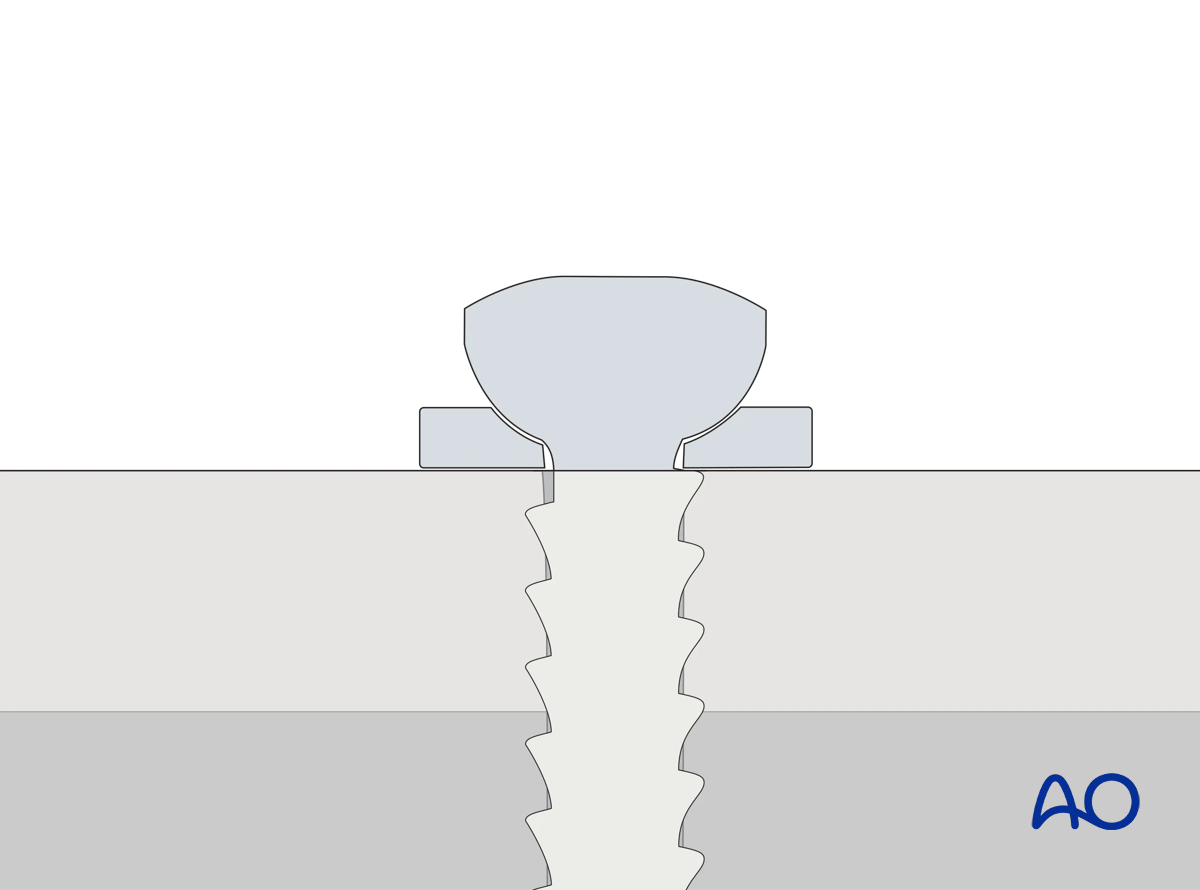 Use of a dished washer