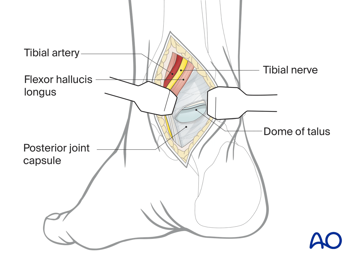 Posteromedial talus approach retract FHL with neurovascular bundle to expose talus fracture; avoid mistaking distal tibia