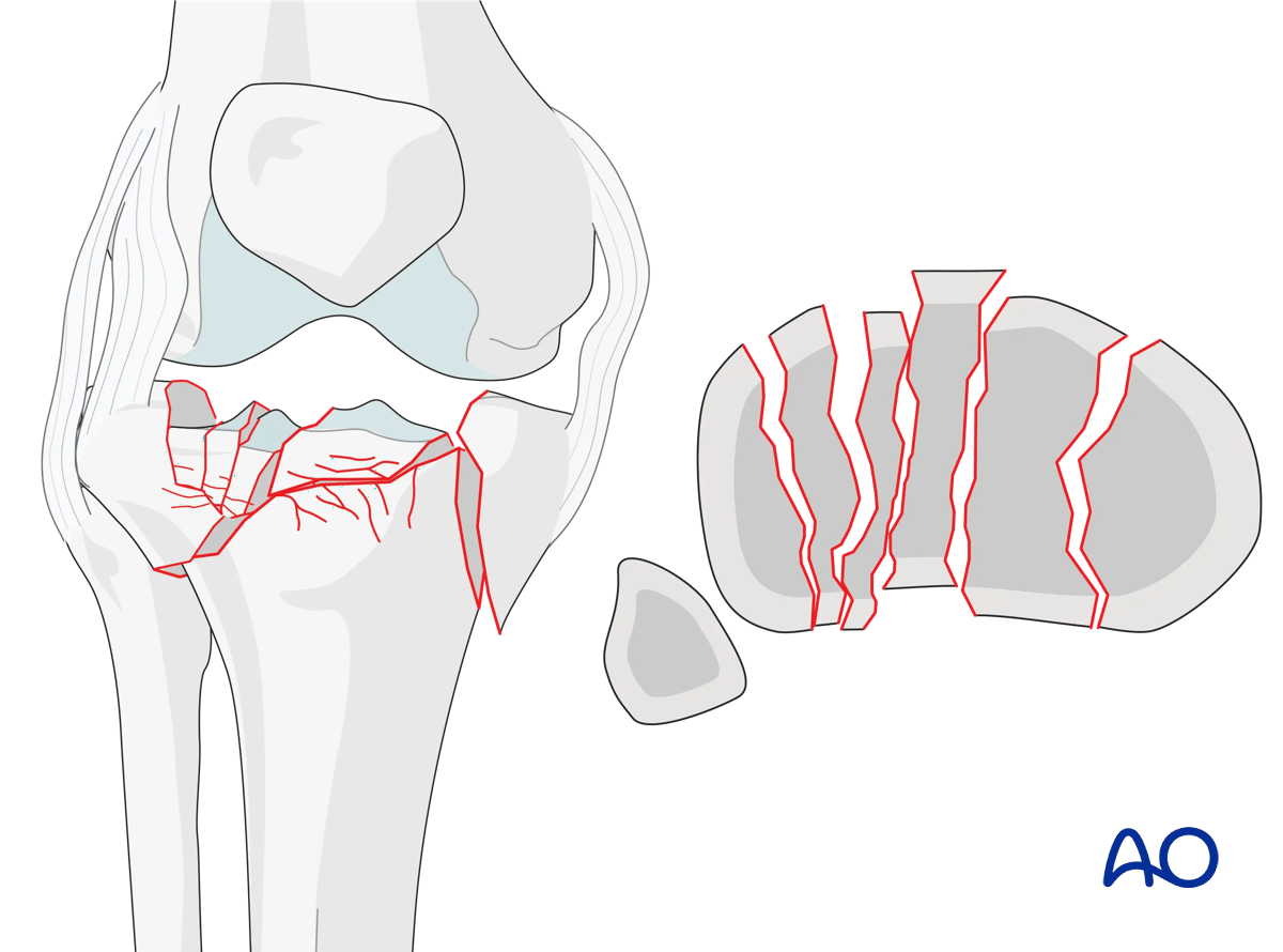 Proximal tibia - Multifragmentary articular fracture characterized by the involvement of both the medial and lateral condyles - classified by the AO/OTA as a 41C3 fracture