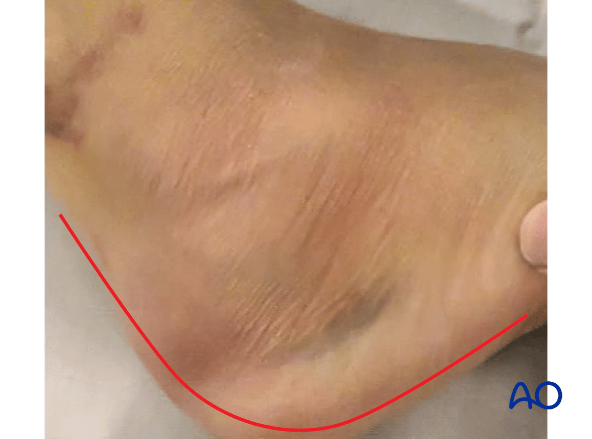Extended lateral approach to the calcaneus: skin incision below bruising; vertical limb shifts midline