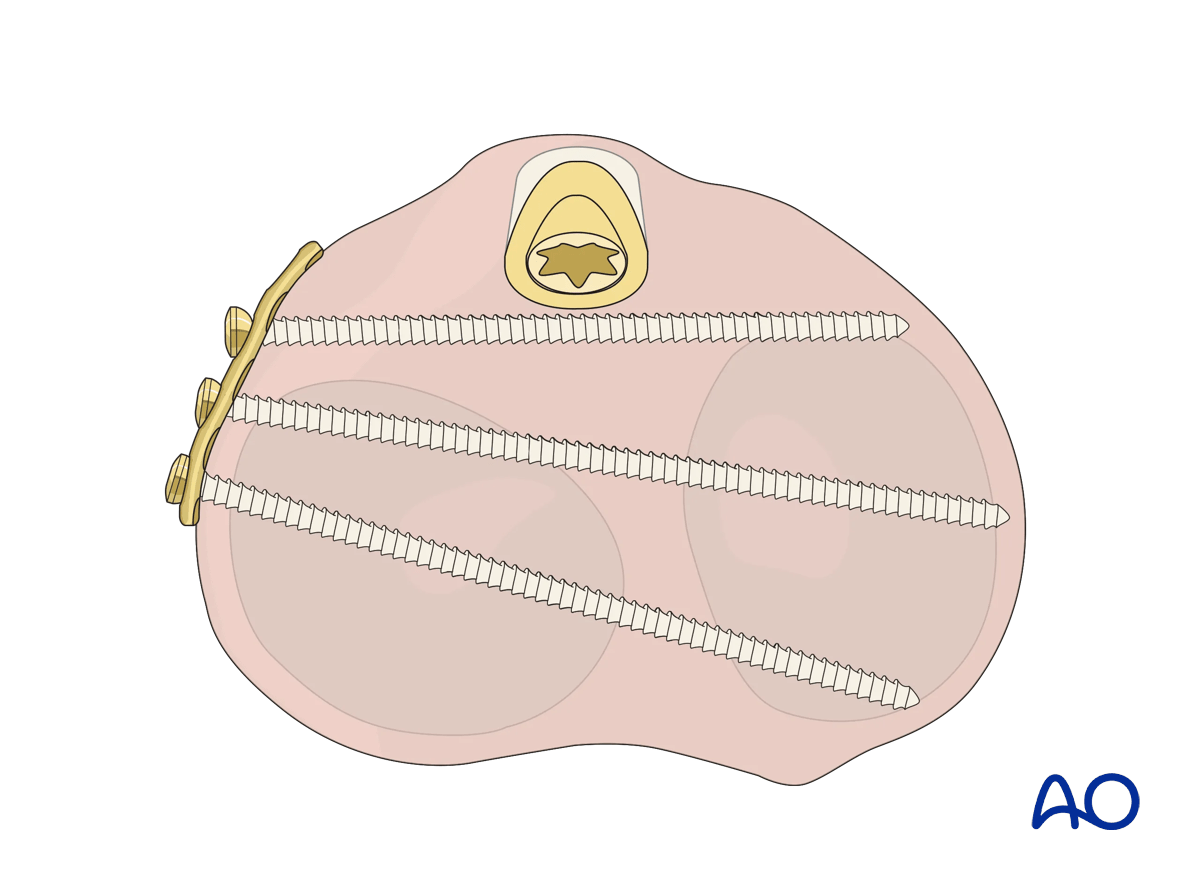 Intramedullary nailing for proximal tibia fractures