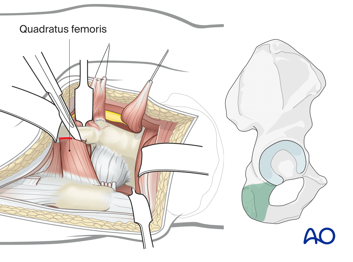 Illustration of Kocher-Langenbeck approach: elevating quadratus femoris to expose distal posterior column.