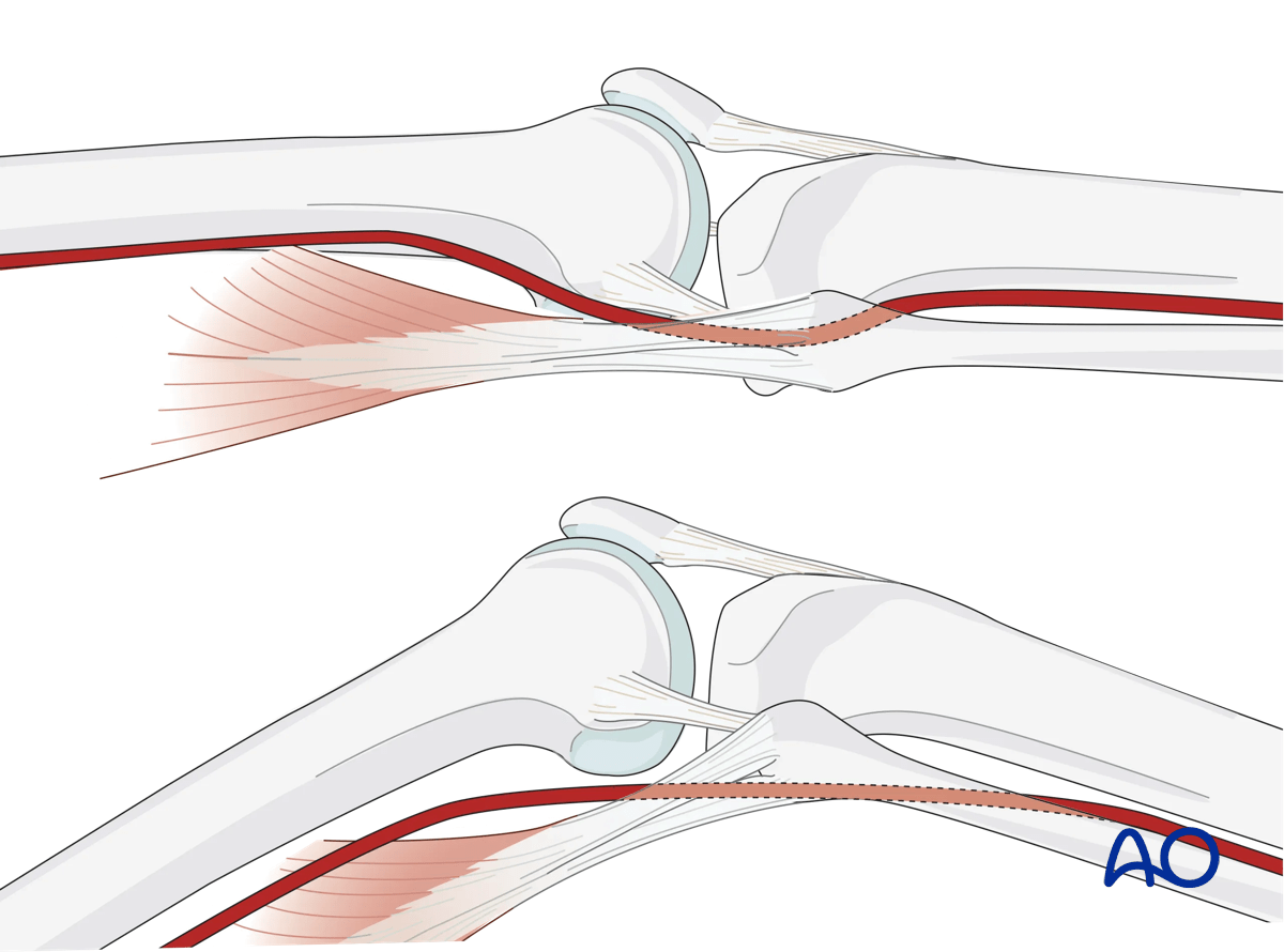 Knee flexion: In full extension the neurovascular bundle is closer to the bone