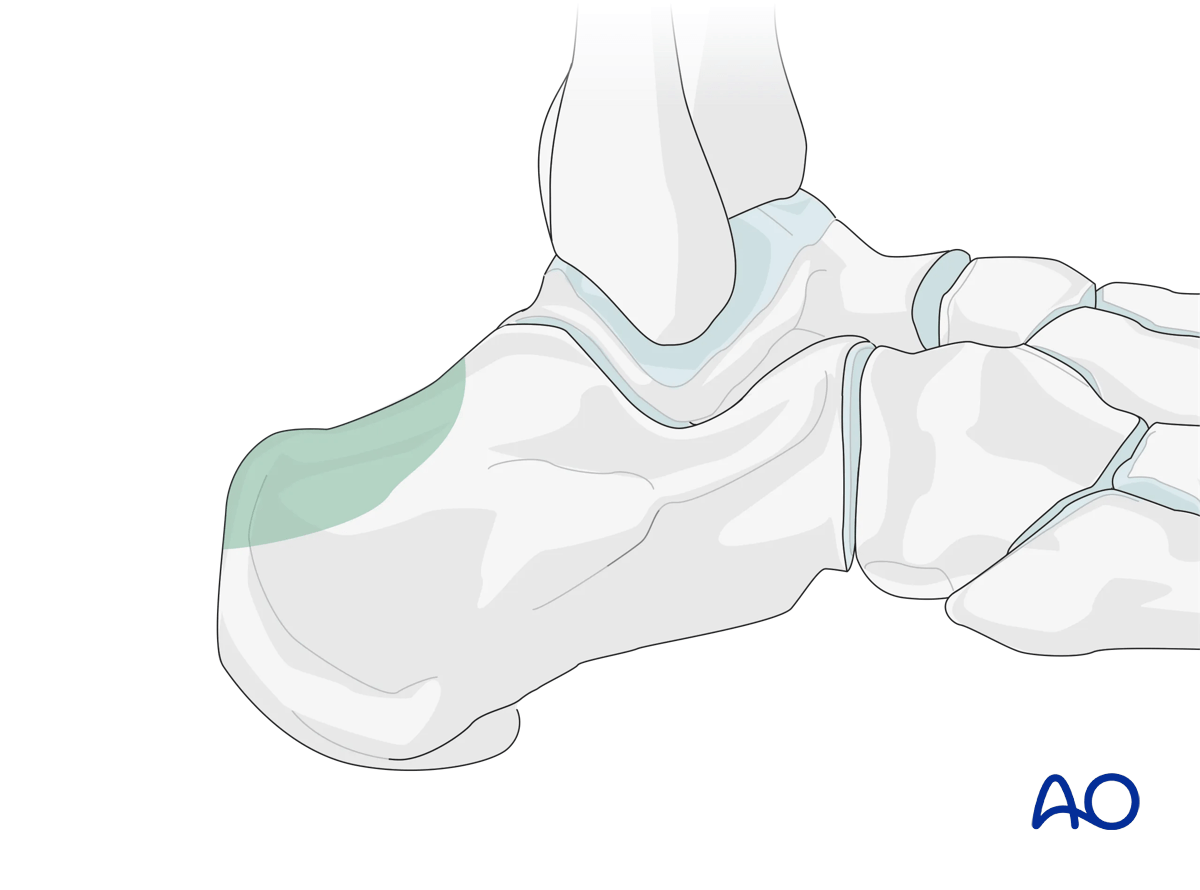 MIO posterior approach to the calcaneus areas of calcaneus visualized.