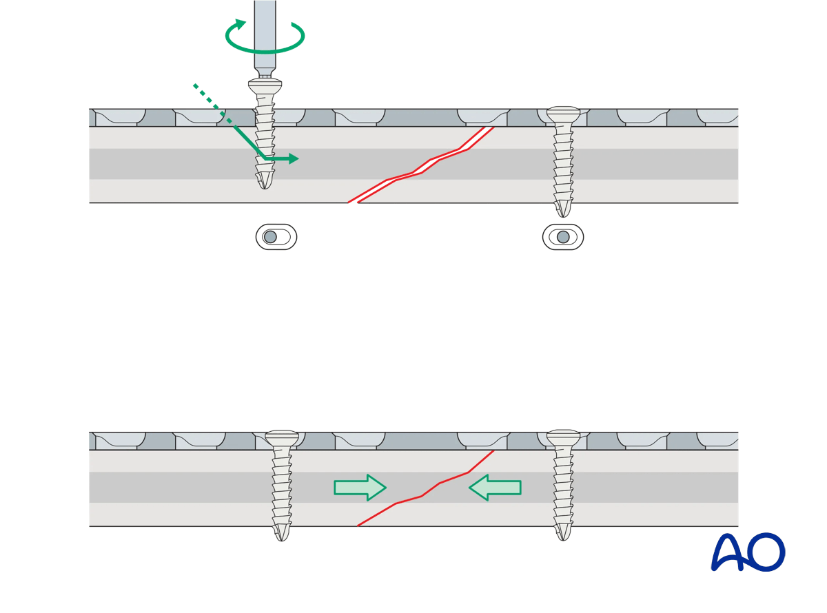 Illustration showing compression mode screw insertion driving the second fragment into the axilla to compress the fracture.