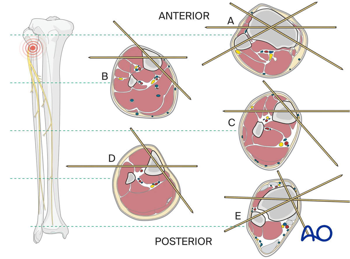 Safe zones in the tibia for wire insertion