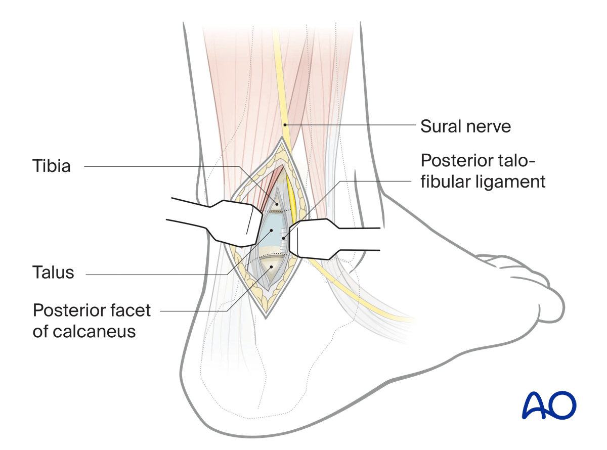 Posterolateral approach hindfoot vertical ankle/subtalar capsulotomy; distractor between tibia and calcaneus aids exposure.