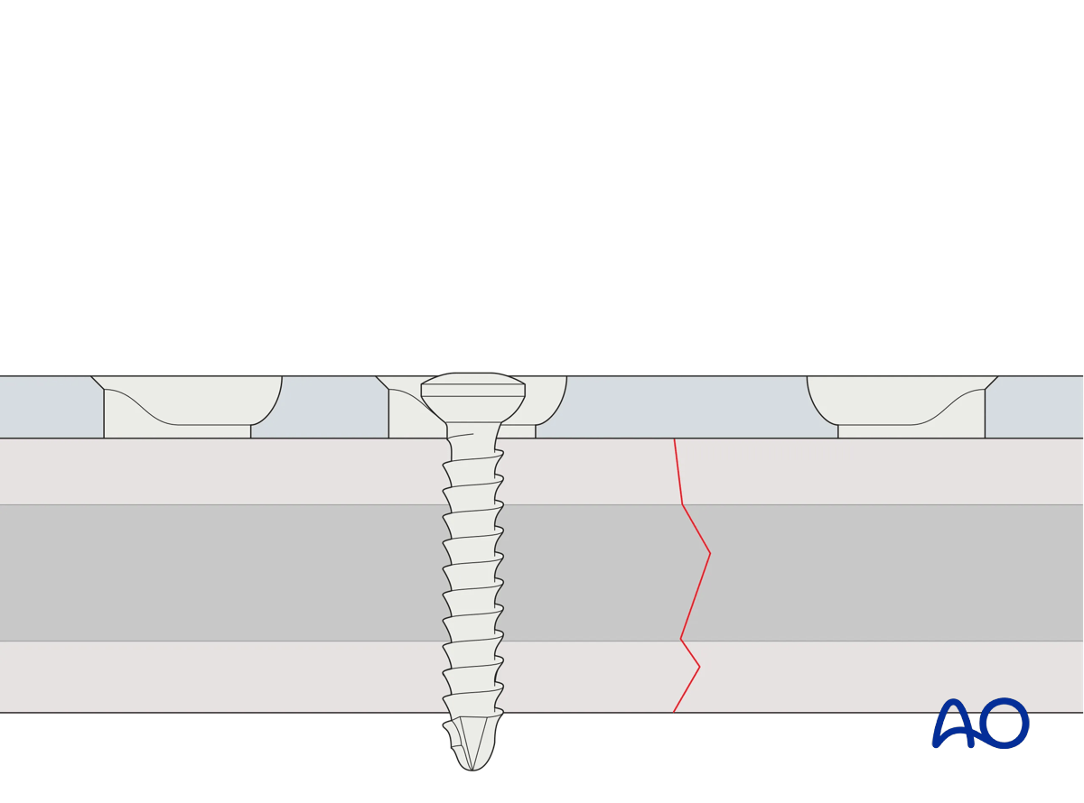 Screw inserted through a plate hole in neutral mode 