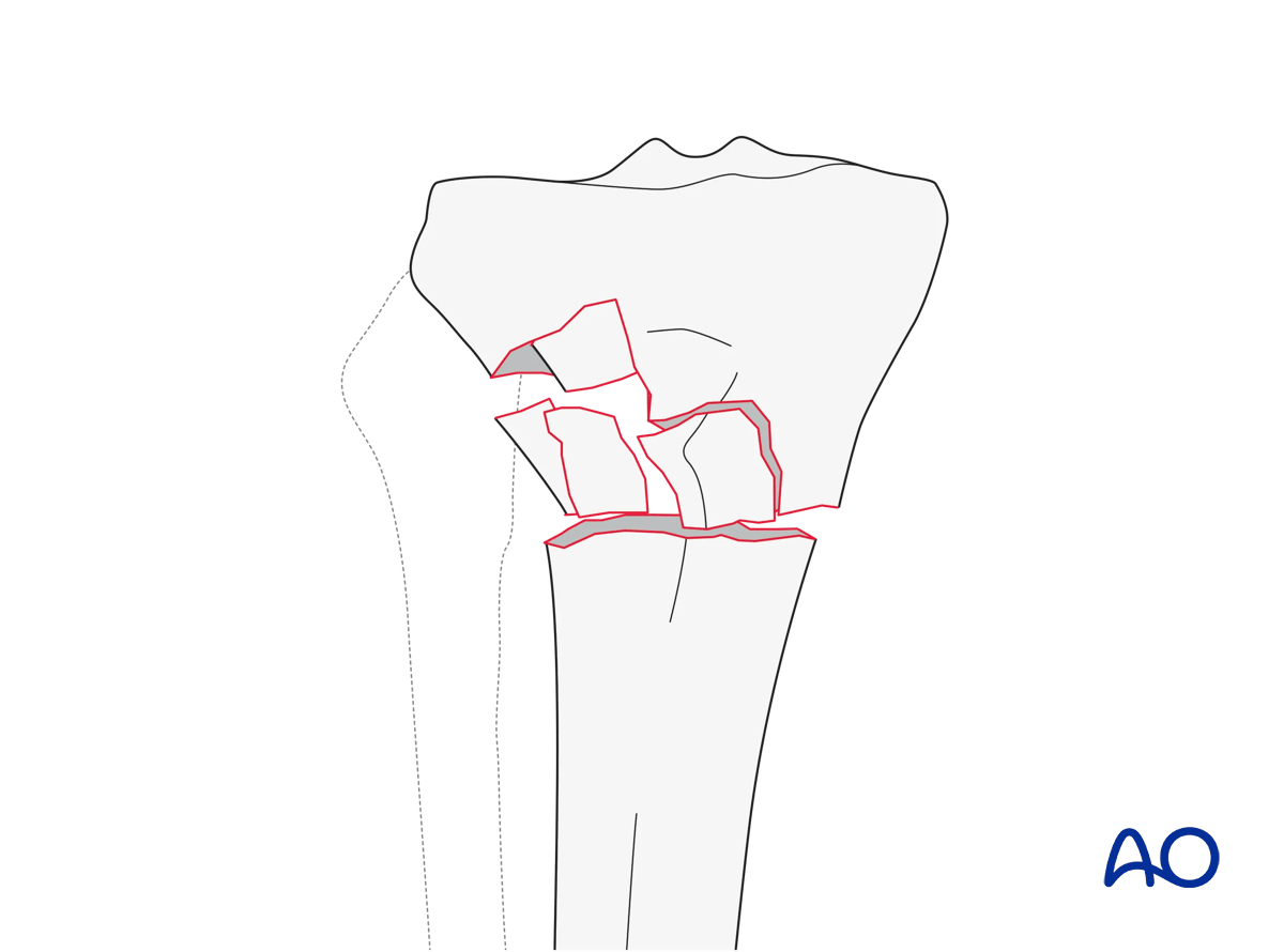 Extraarticular fracture, metaphyseal wedge or multifragmentary (AO/OTA 41A3)