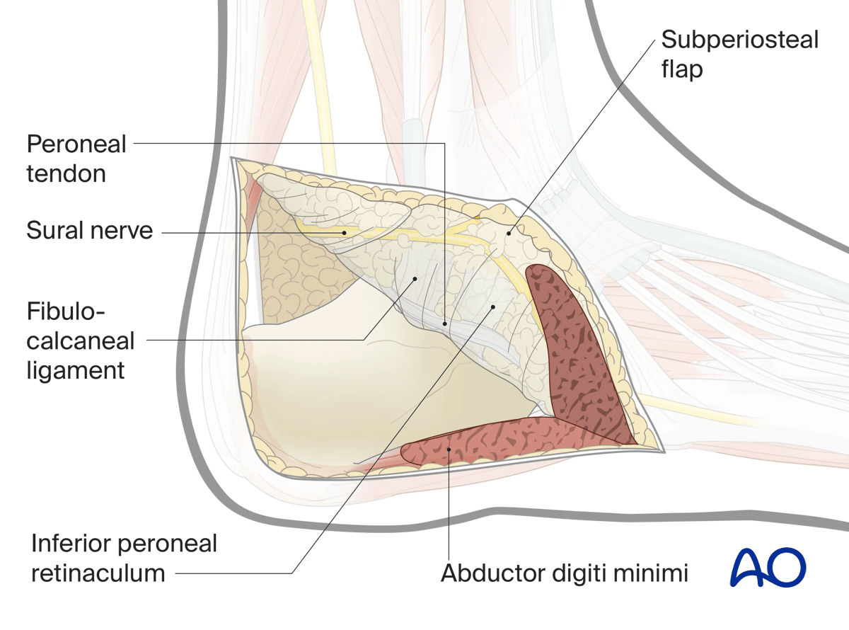 Extended lateral approach to the calcaneus: subperiosteal dissection elevates periosteum; protect artery