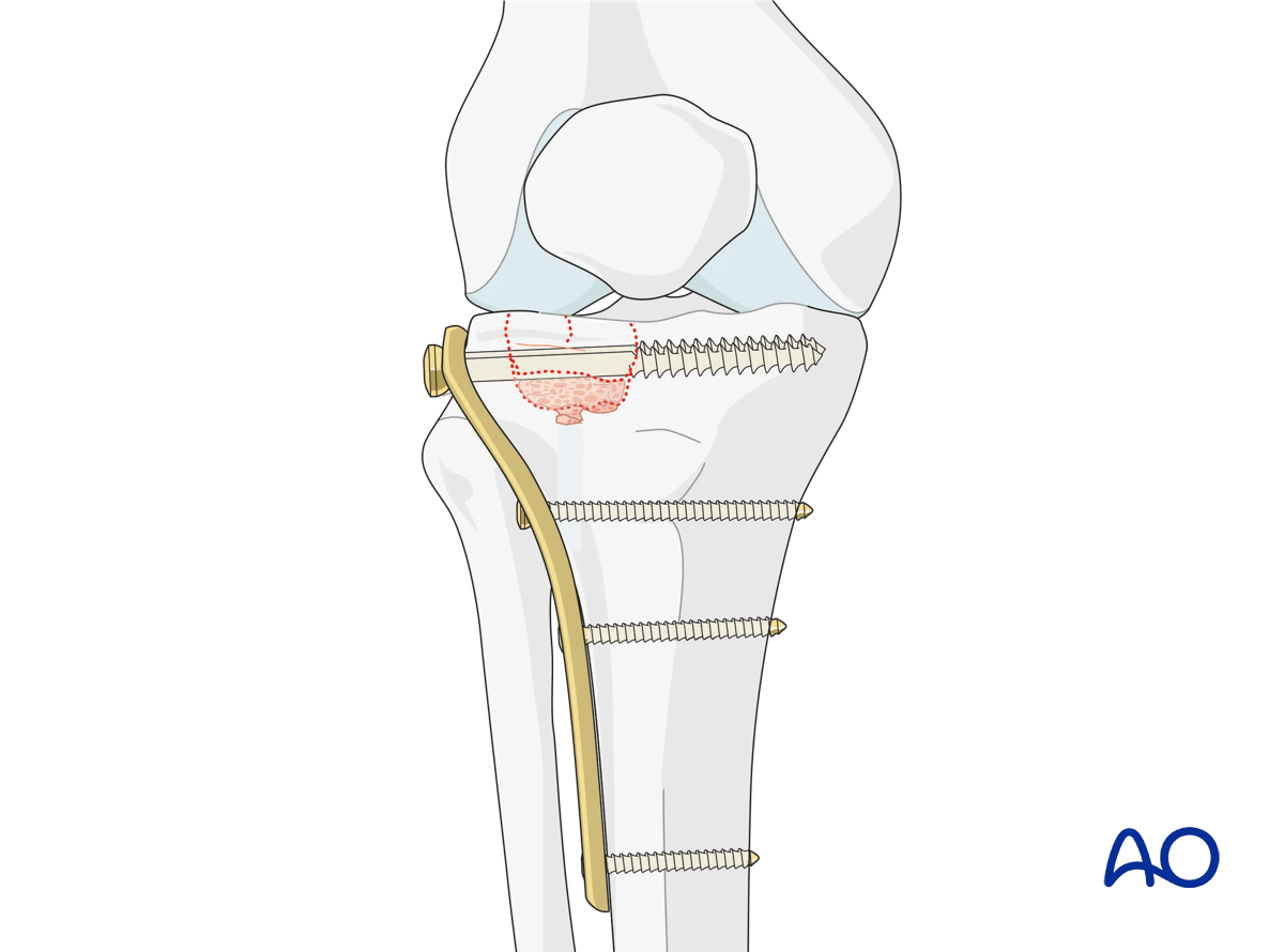Proximal tibia depression fracture: ORIF - Conventional plating, final osteosynthesis