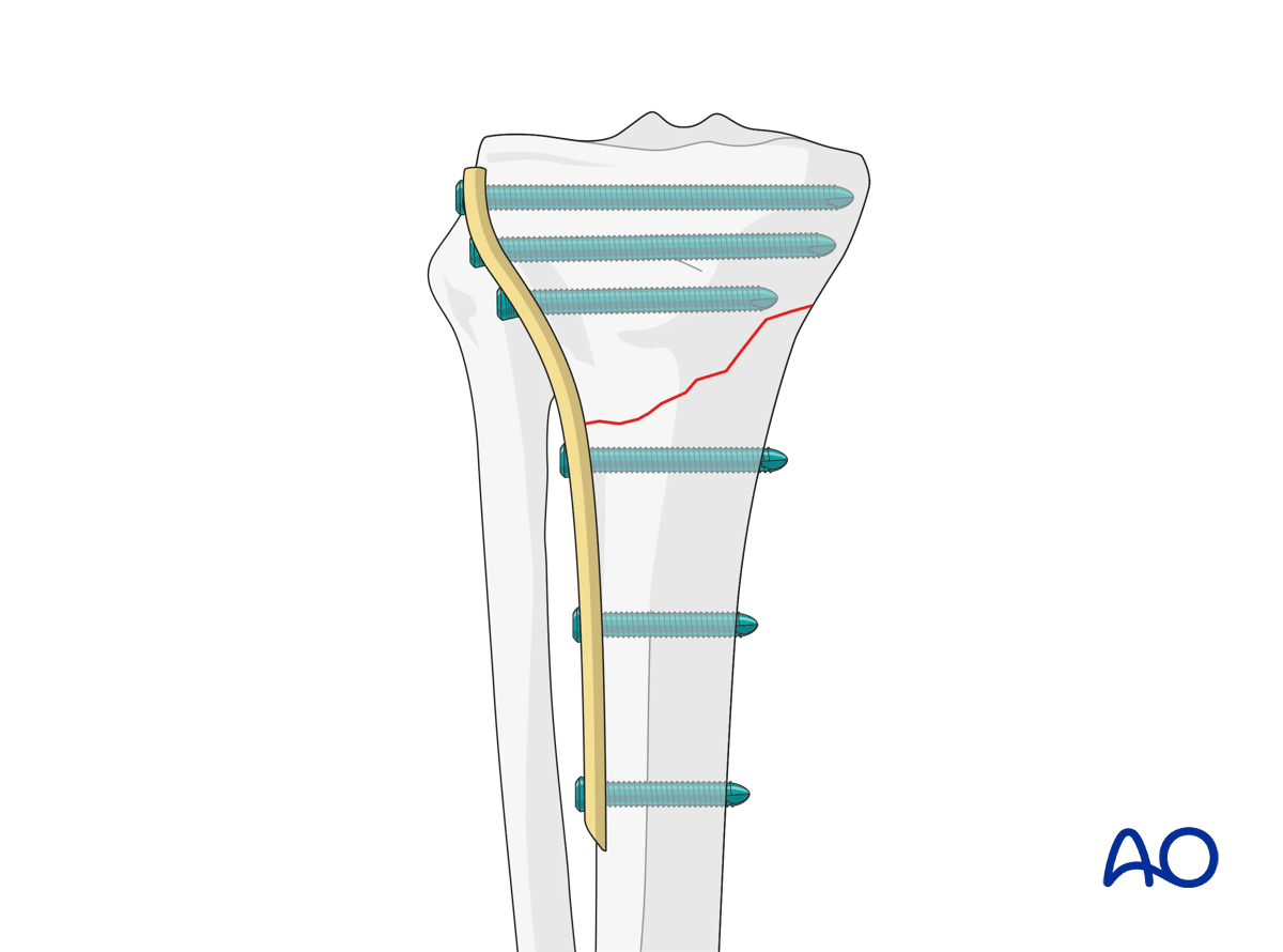 Proximal tibia: Simple extraarticular fracture of the metaphysis Angular stable plating