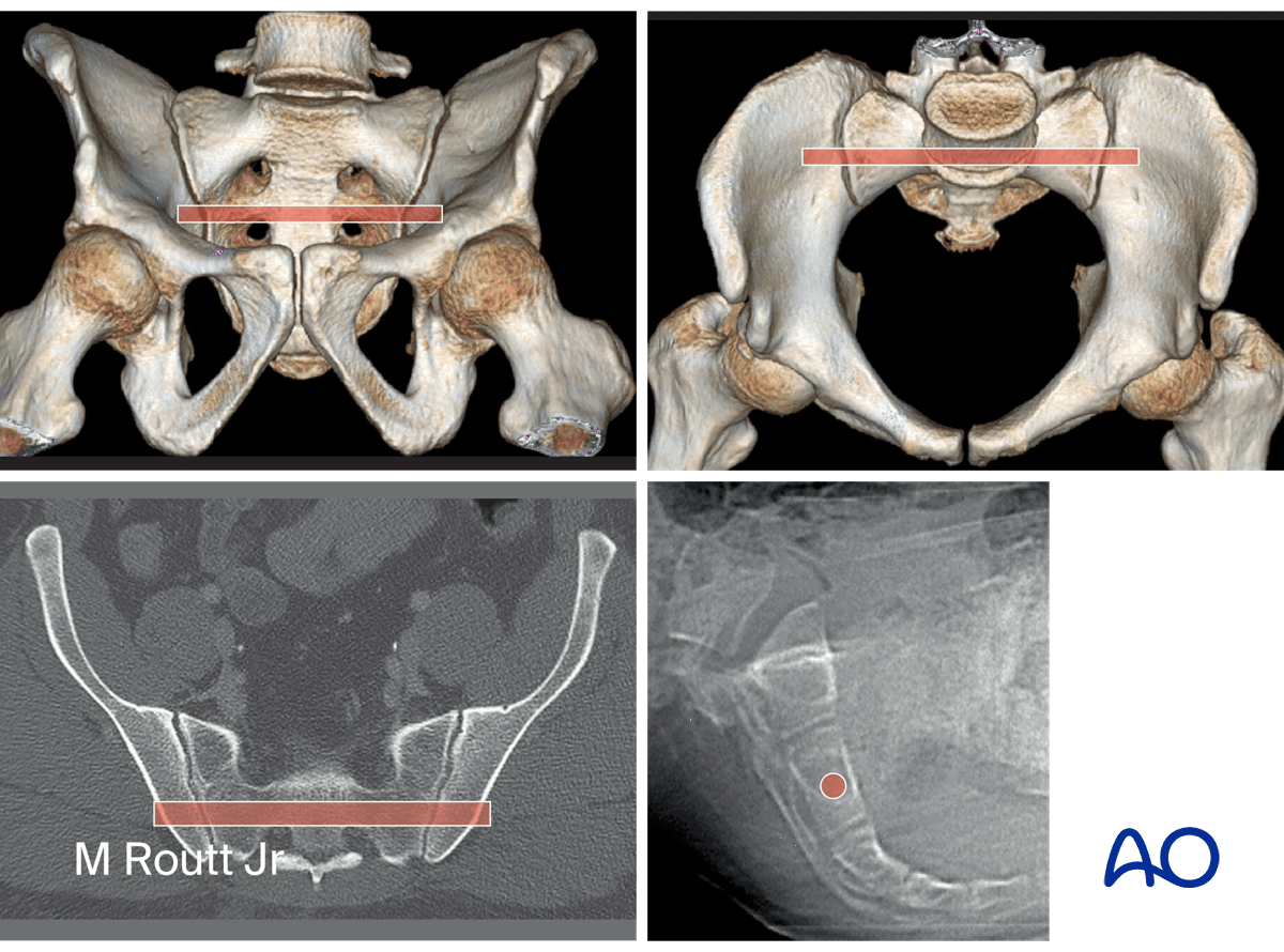 Planning for IS screw insertion