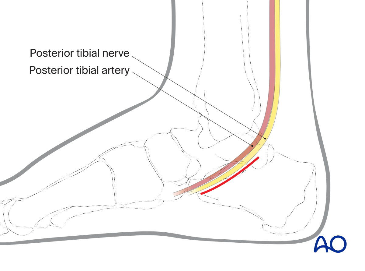 Skin incision line in medial approach to the calcaneus