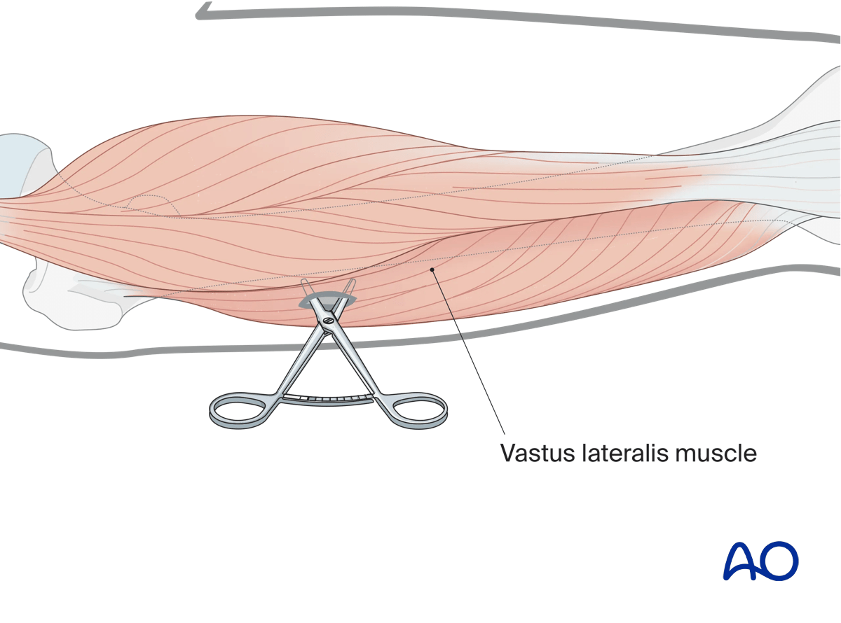 Tibia: temporary bridging external fixator: preparing a channel for the insertion of a pin