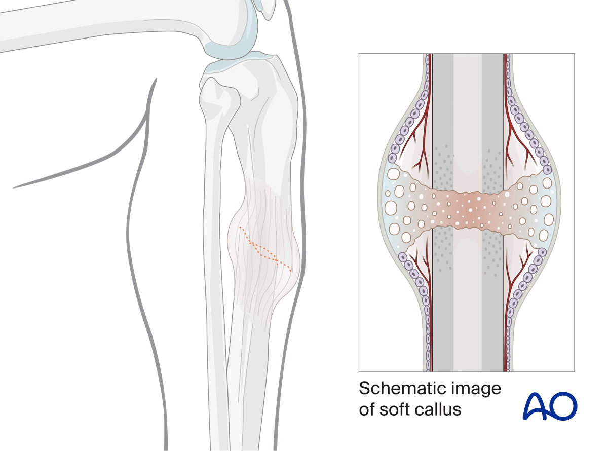 Lateral parapatellar intramedullary nailing of the tibial shaft, Reduction difficulties