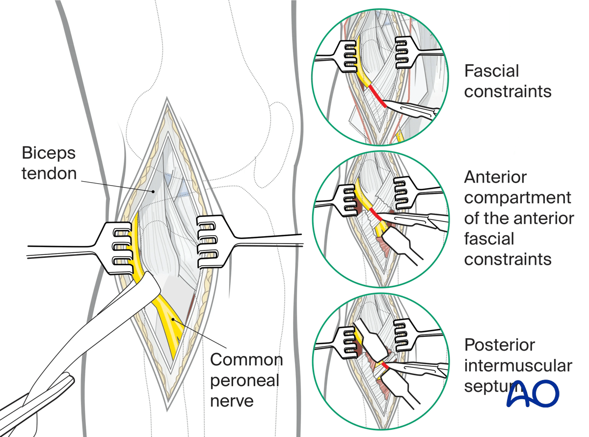 Straight lateral approach, opening the fascia