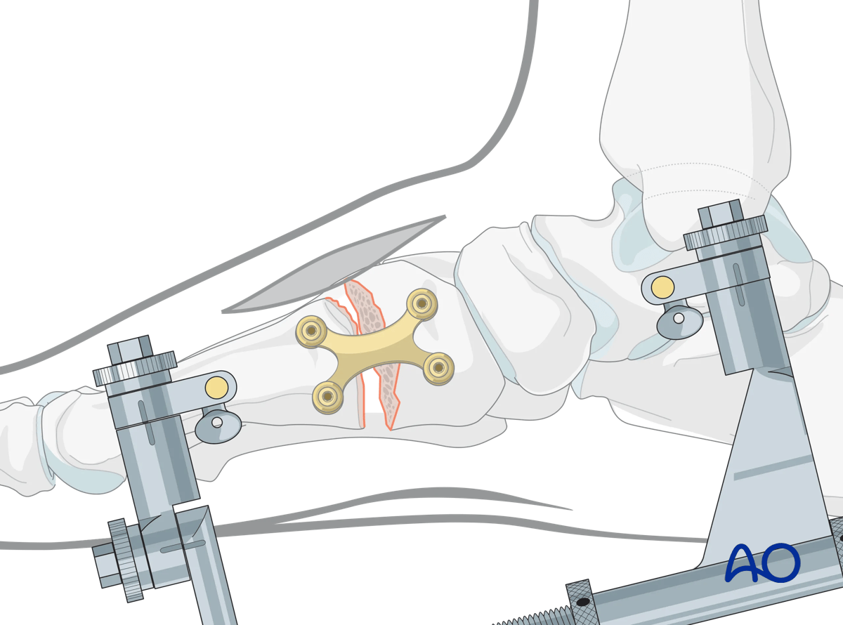 Fusion of TMT joint with distal multifragmentary cuneiform fracture. Applied distractor and plate.