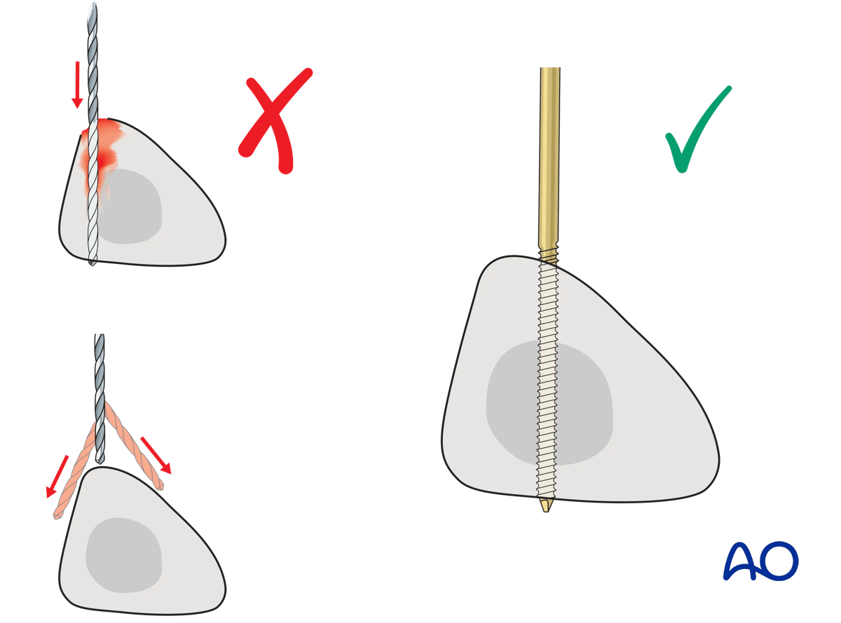 Tibia: temporary bridging external fixator: pin placement