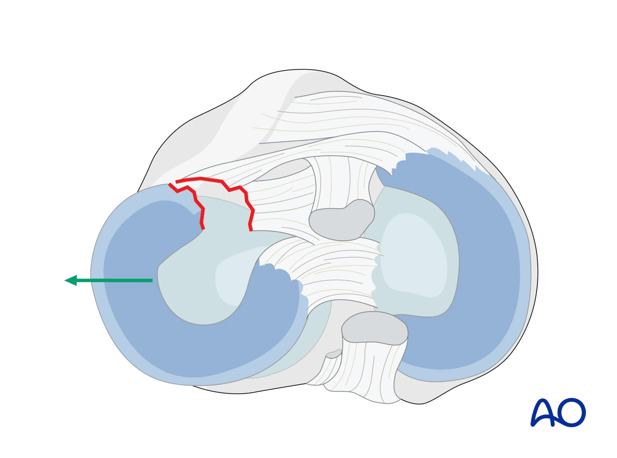 Extended anterolateral approach to the proximal tibia