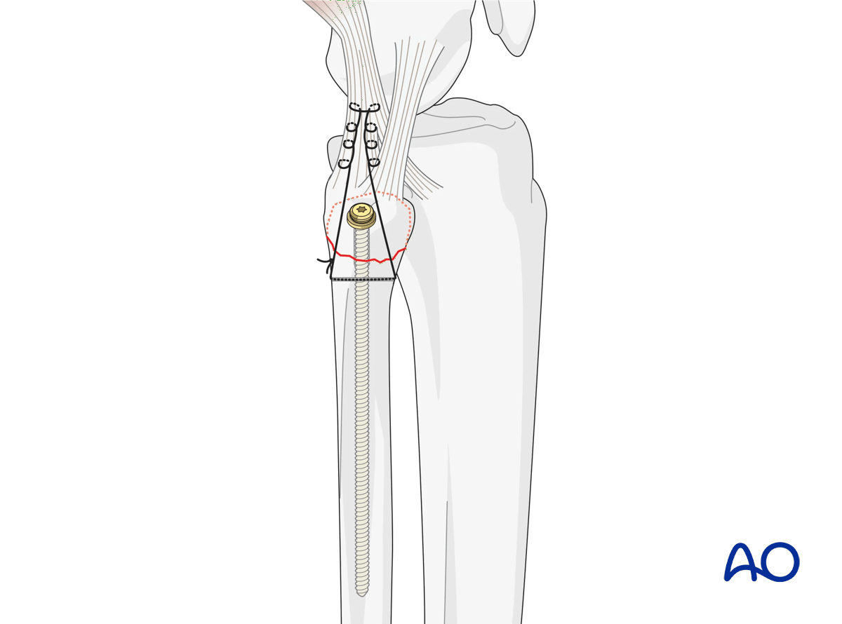 Extraarticular avulsion of fibular head: Suture and screw fixation