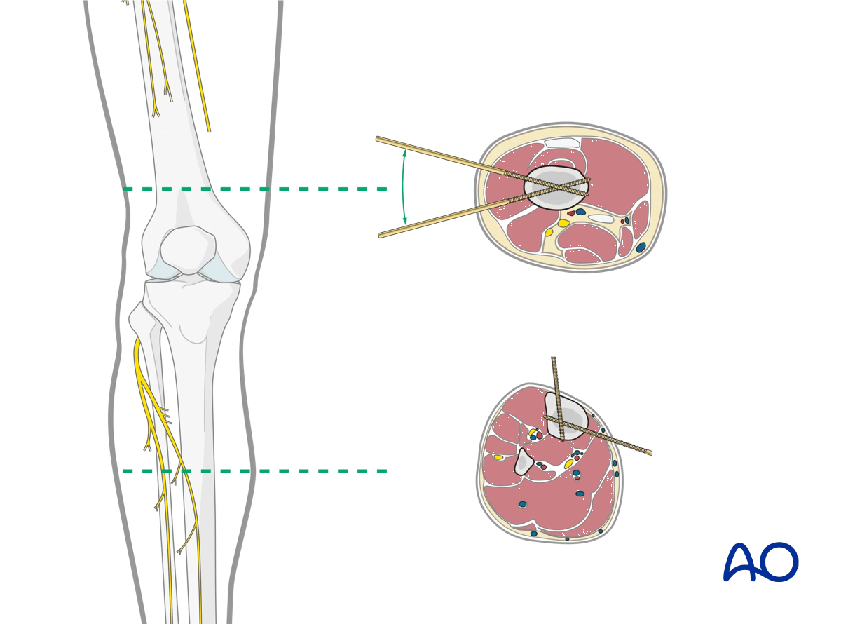 Tibia: safe zones for pin insertion