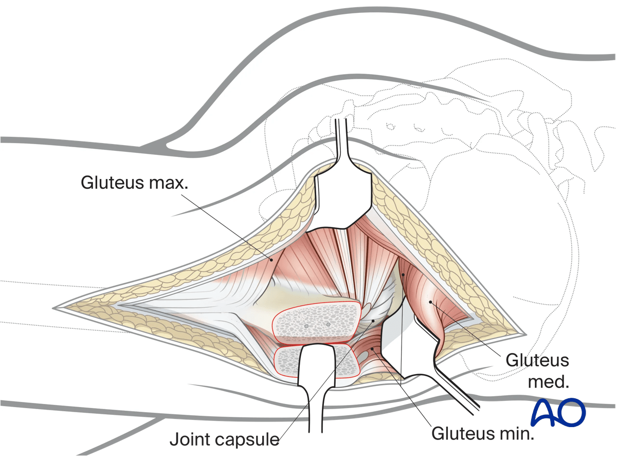 Illustration of Kocher-Langenbeck approach: mobilizing trochanteric fragment for access to supraacetabular surface.