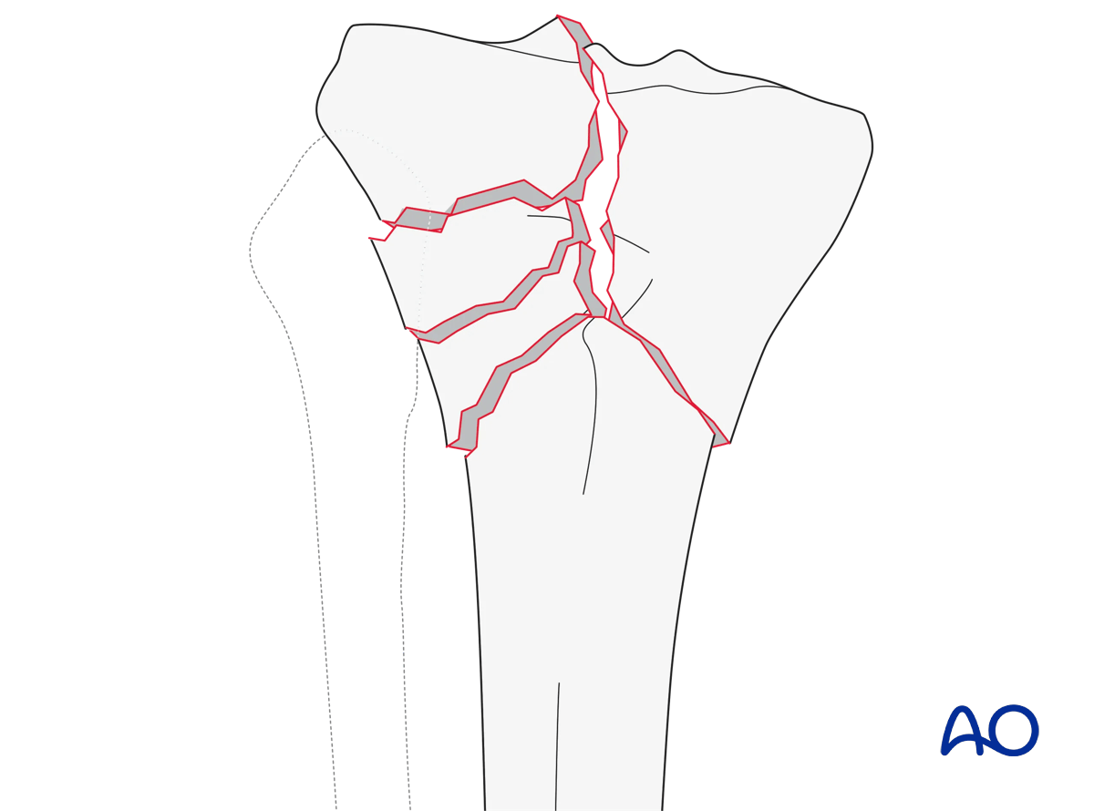 Complete articular fracture, simple articular, multifragmentary metaphyseal (AO/OTA 41C2)