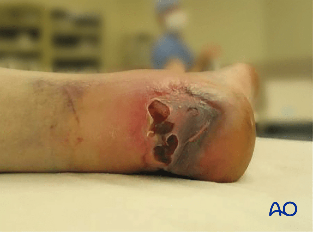 MIO posterior approach: tuberosity fracture endangering skin; urgent reduction may modify incision.