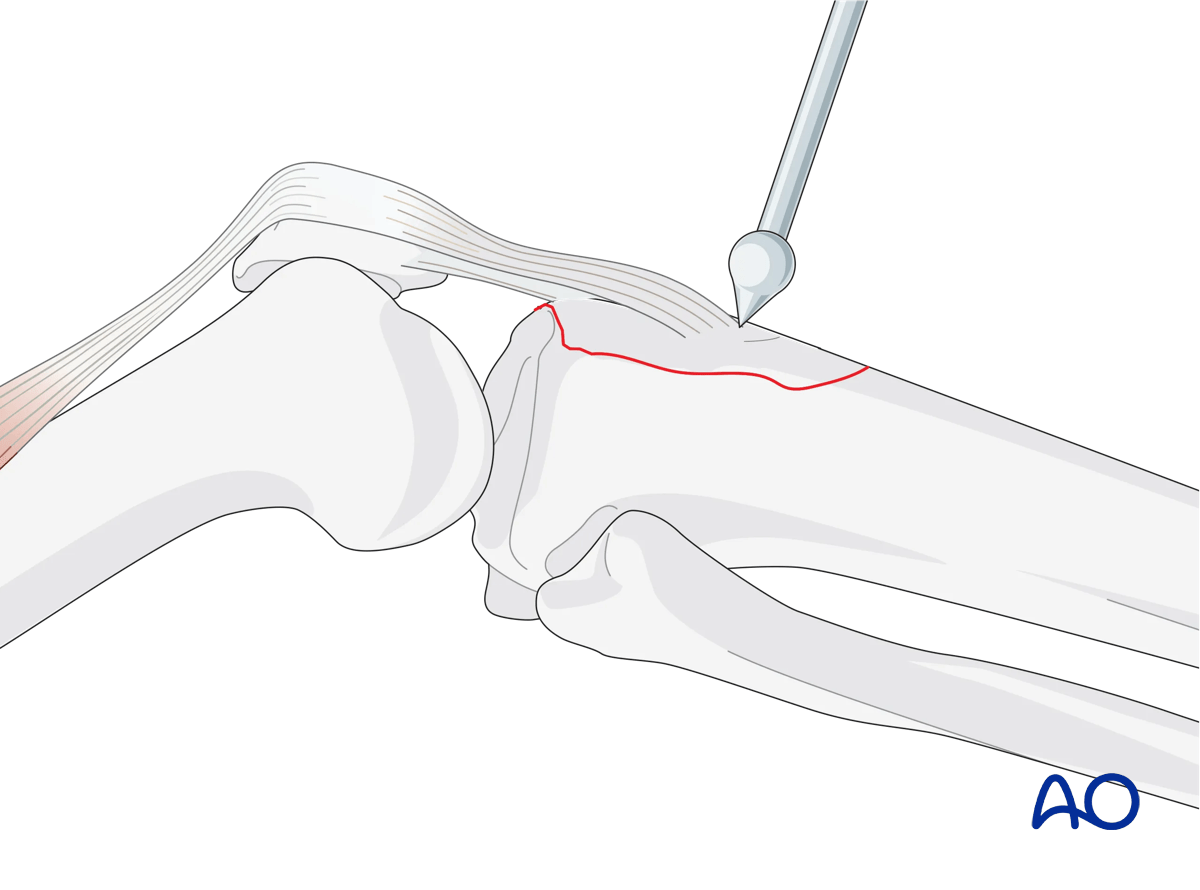 Avulsion of tibial tubercle: Reduction with ball-spiked pusher