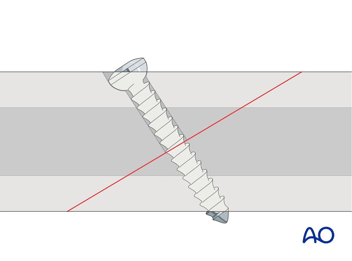 Compression of oblique fracture