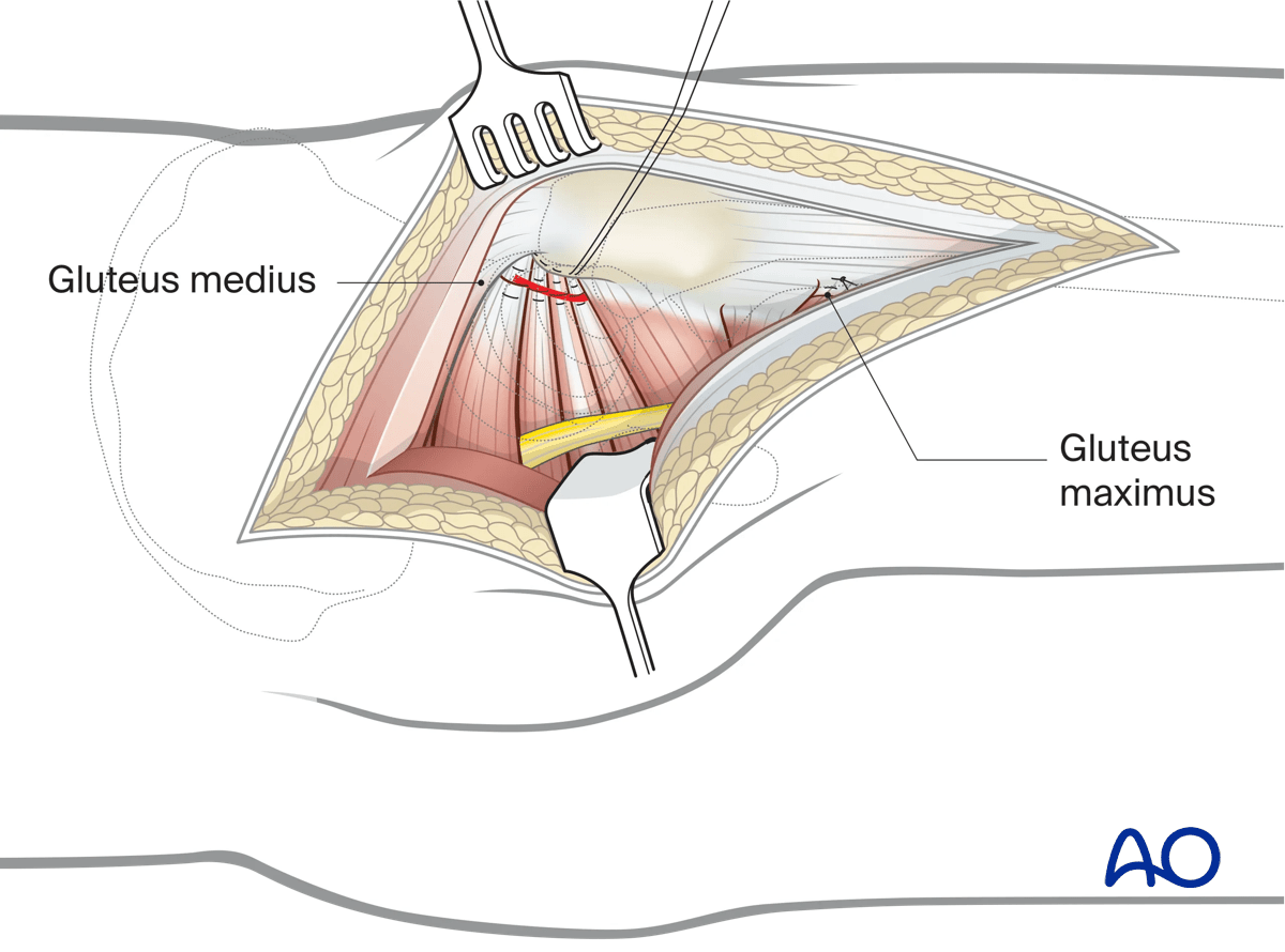 Capsule and tendons repair in a Kocher-Langenbeck approach to the hip