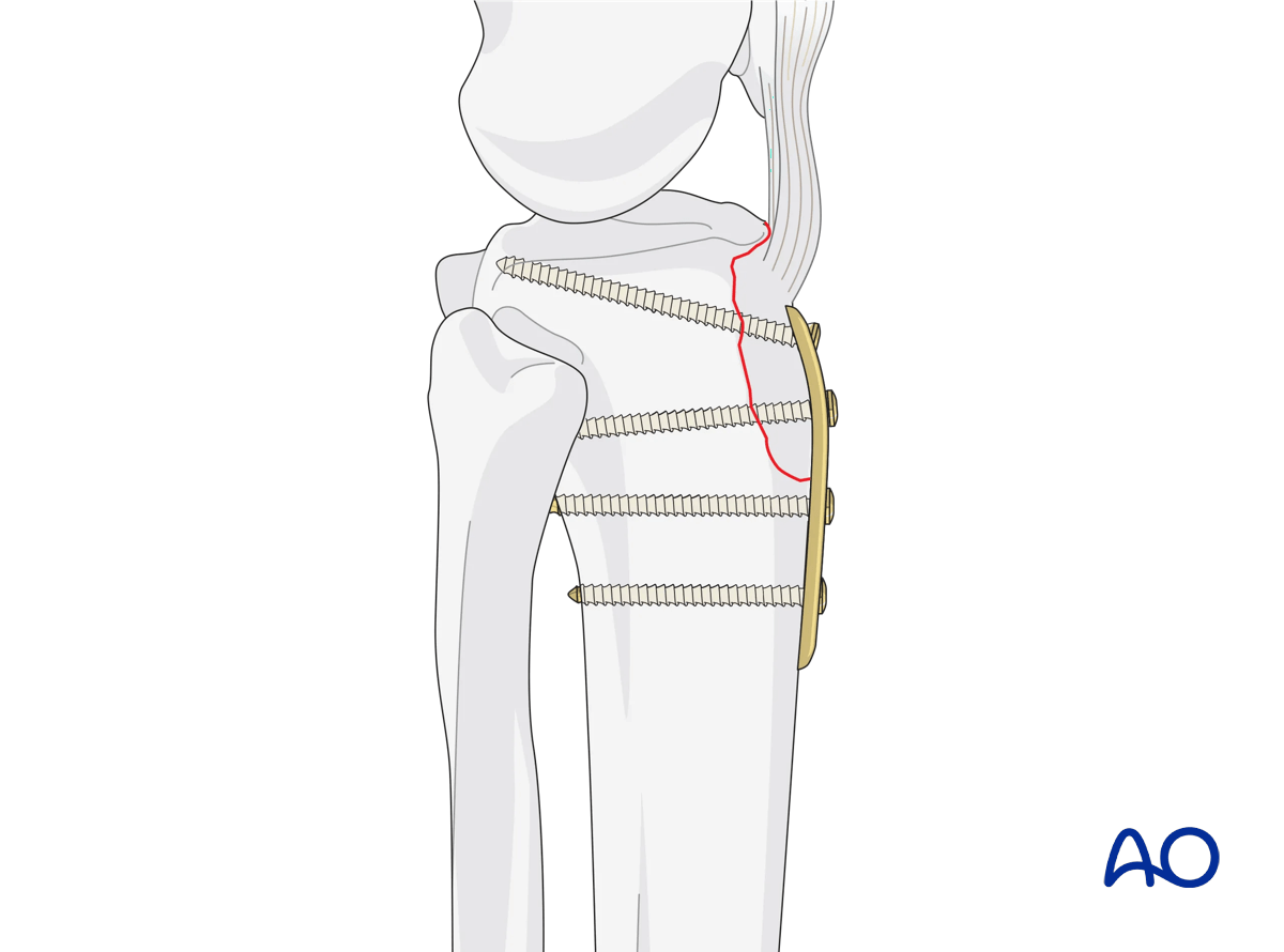 Extraarticular fracture avulsion of tibial tubercle - ORIF - Conventional plating – final osteosynthesis