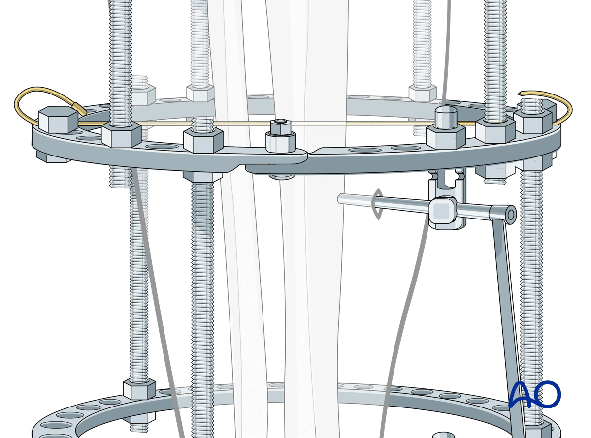 Proximal tibia fracture – ring fixation: Schanz screw mounting with multiparallel pin clamp