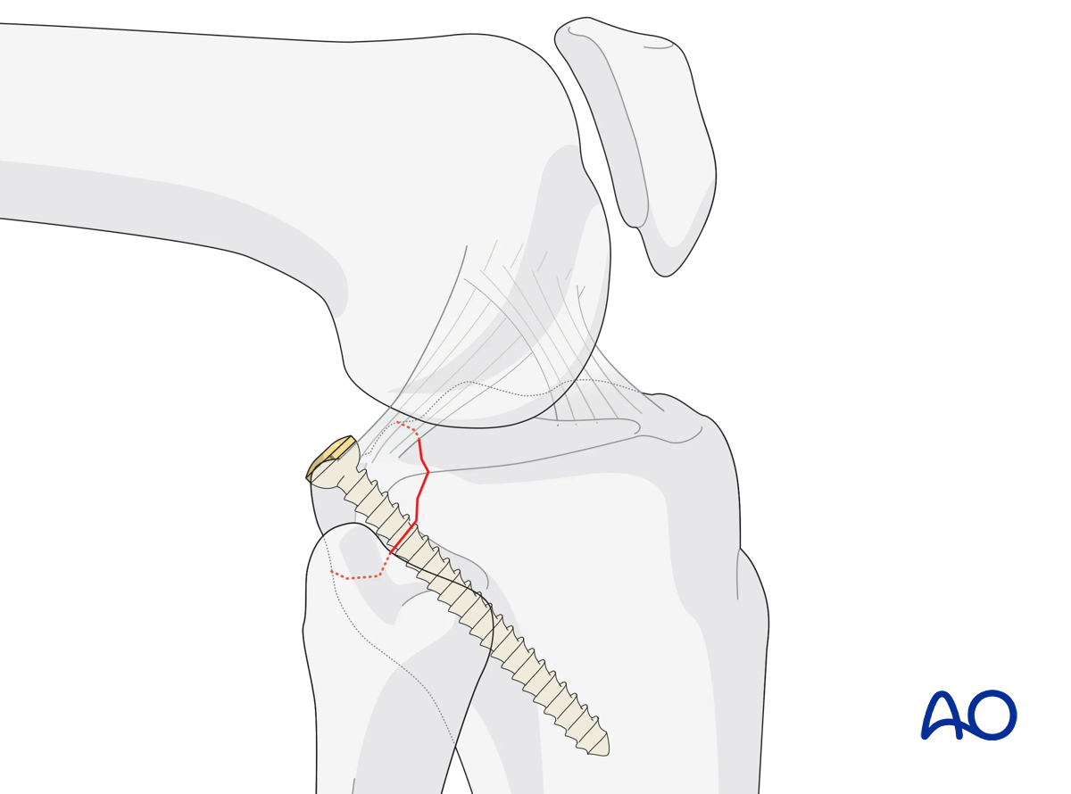 Posterior cruciate avulsion - Fixation