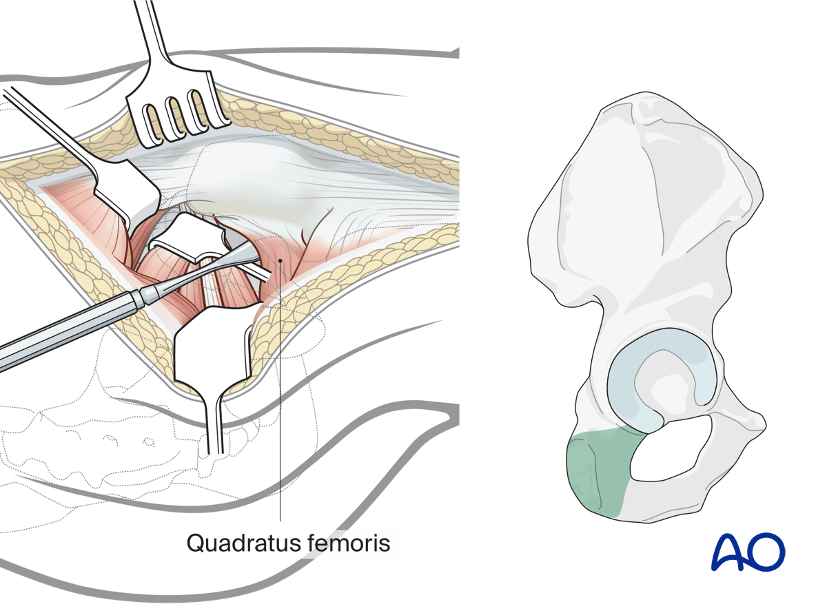 Additional caudal exposure in a Kocher-Langenbeck approach to the hip