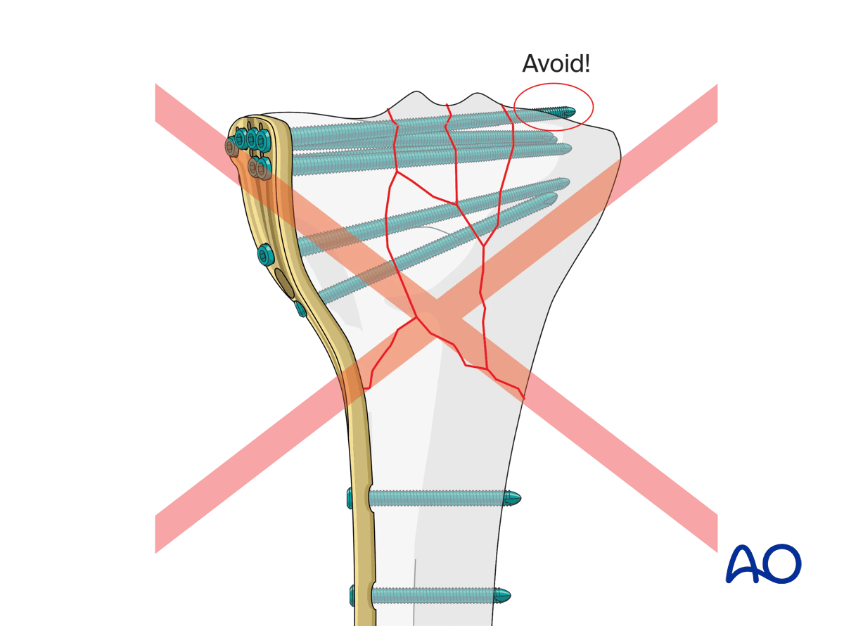 Proximal tibia: complete articular fracture - Angular stable plating – plate positioning