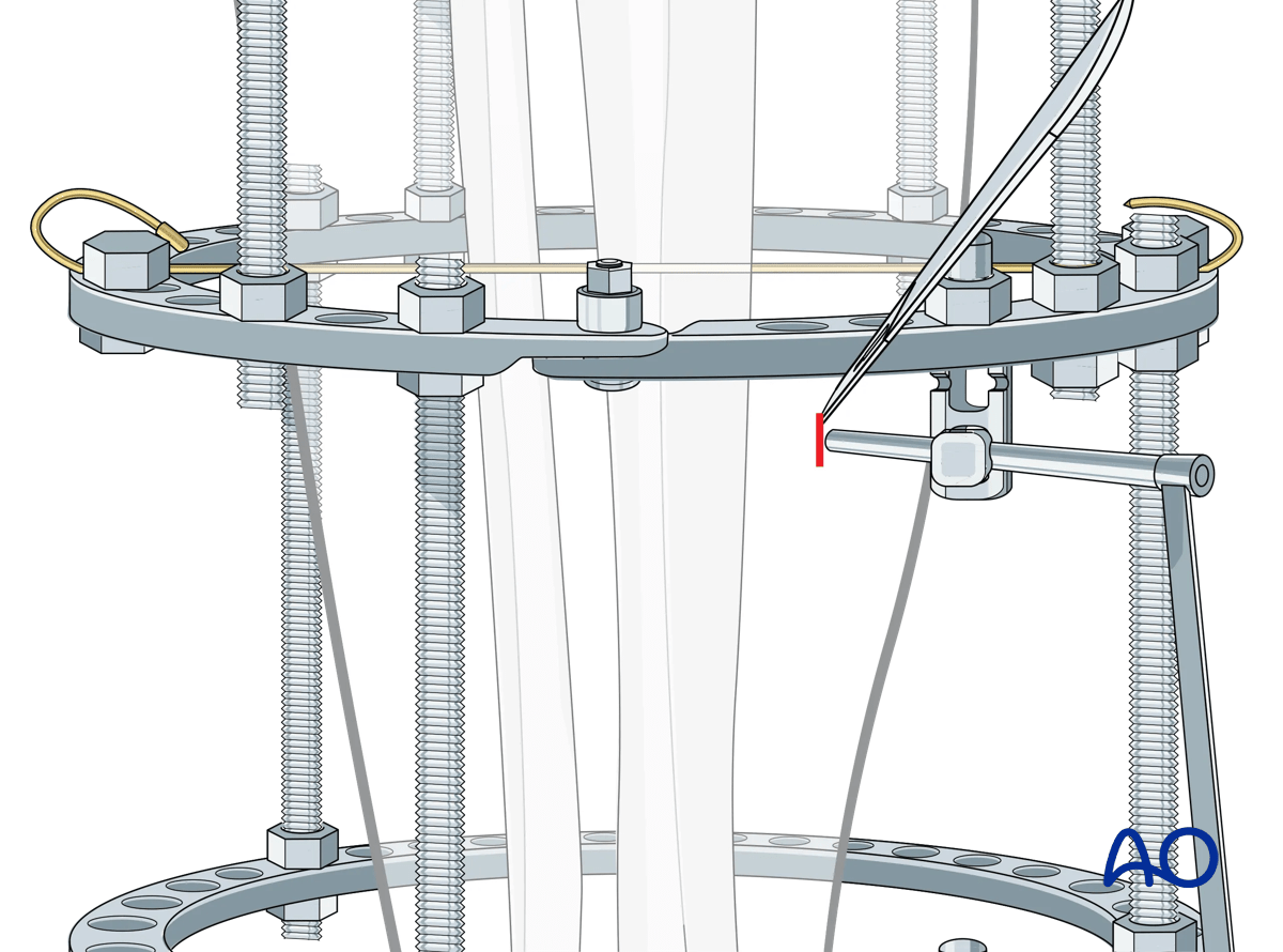 Proximal tibia fracture – ring fixation: Schanz screw mounting with multiparallel pin clamp