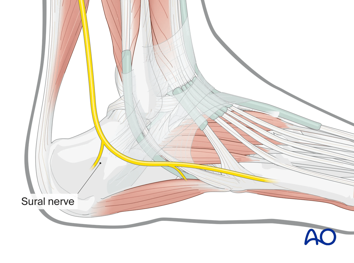 Sinus tarsi approach to the calcaneus with care to protect the sural nerve