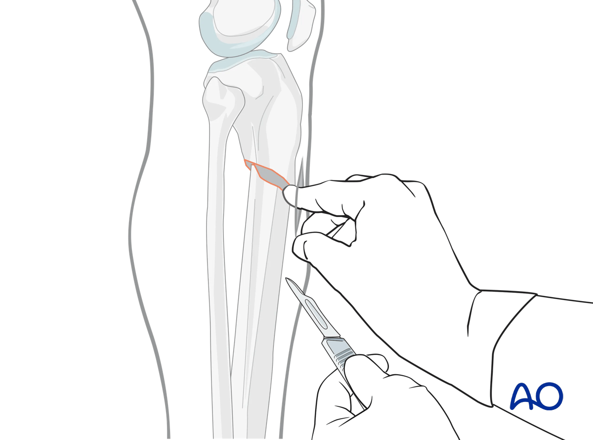Suprapatellar intramedullary nailing, open reduction, incision