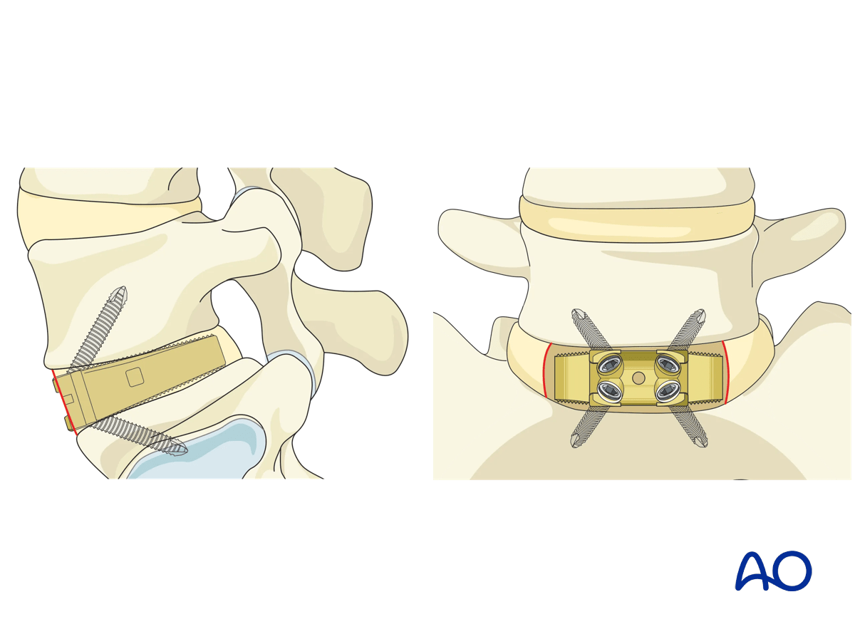 Anterior lumbar interbody fusion (ALIF)