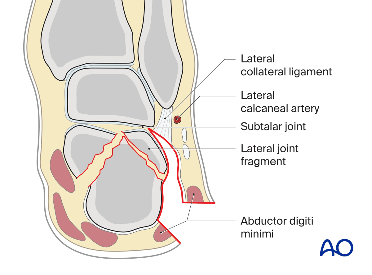 Extended lateral approach to the calcaneus: dissection to subtalar joint; semicoronal view of fracture
